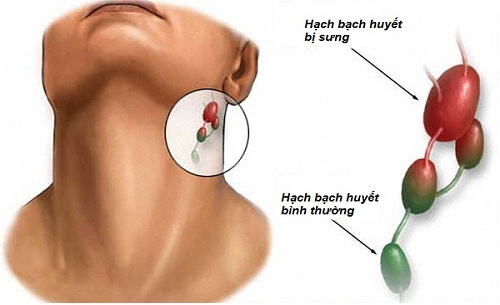 Bạch huyết viêm amidan - Hình ảnh minh họa